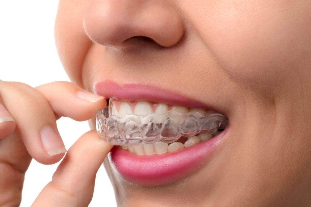 Invisalign Treatment in Oxnard CA