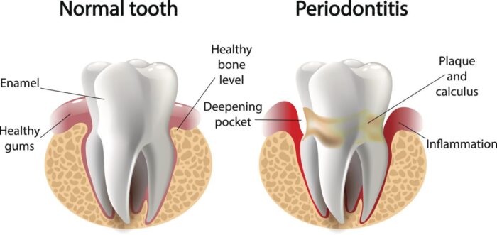 treatment for gum disease oxnard ca