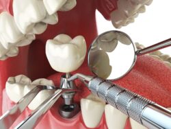 affordable dental implants in oxnard, california