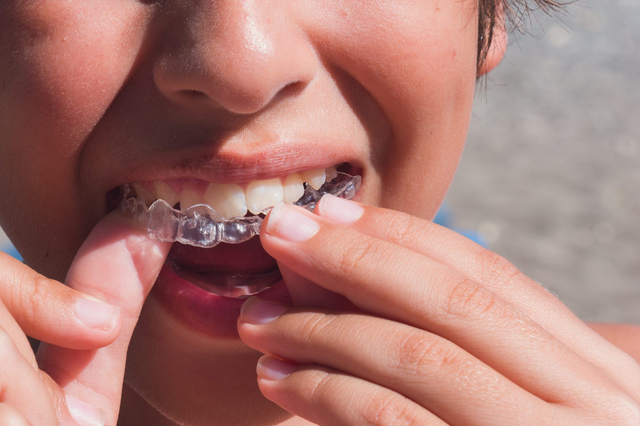 Why Patients Prefer Clear Braces - Dentist in Oxnard, CA