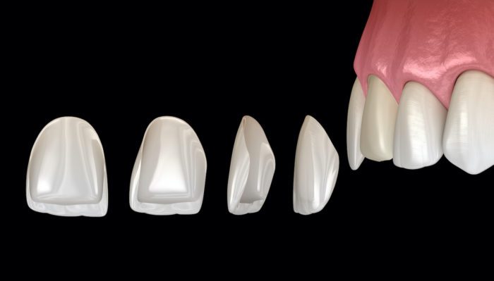 affordable porcelain veneers in ventura, california