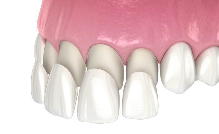 affordable porcelain veneers in camarillo ca