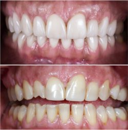 no prep veneers in oxnard, california