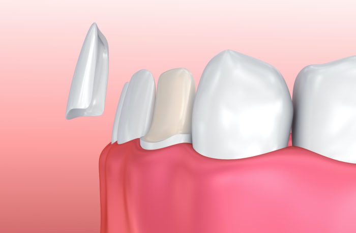 porcelain veneers in port hueneme, california