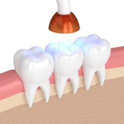 Finding the Best Material for Filling a Tooth Cavity - West Hollywood  Holistic and Cosmetic Dental Care