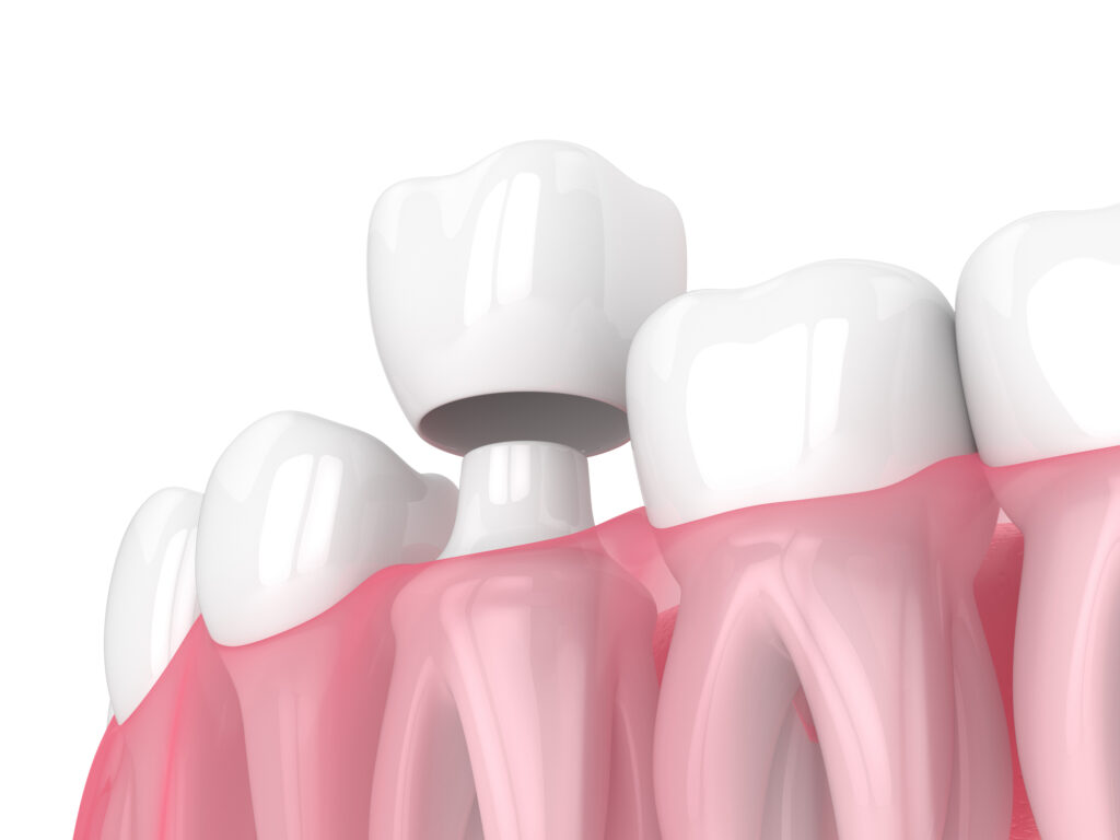 DENTAL CROWNS in OXNARD CA work to preserve as much of your natural tooth as possible.