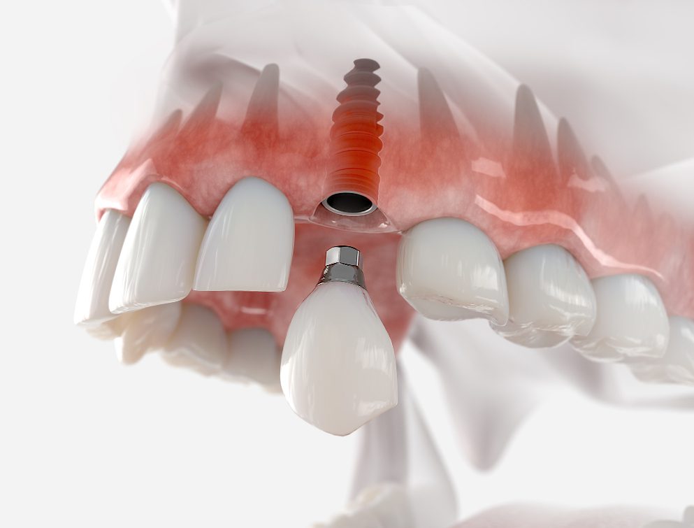 DENTAL IMPLANTS in OXNARD CA can take some time, but they offer great benefits