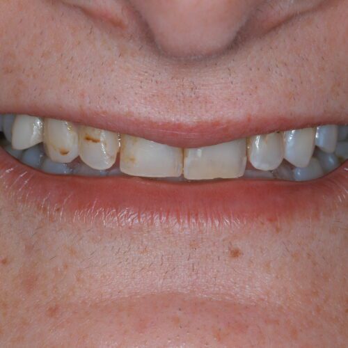 Before dentistry at Beach Cities Dental Group