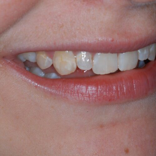 Before dentistry at Beach Cities Dental Group