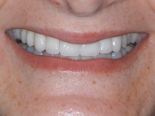 After dentistry at Beach Cities Dental Group