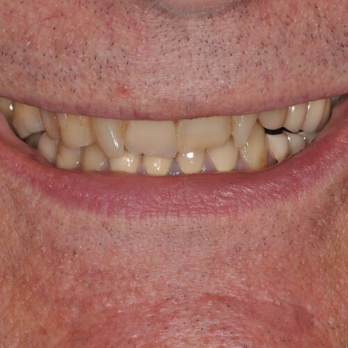 Before dentistry at Beach Cities Dental Group