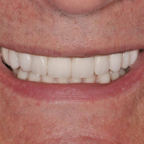 After dentistry at Beach Cities Dental Group