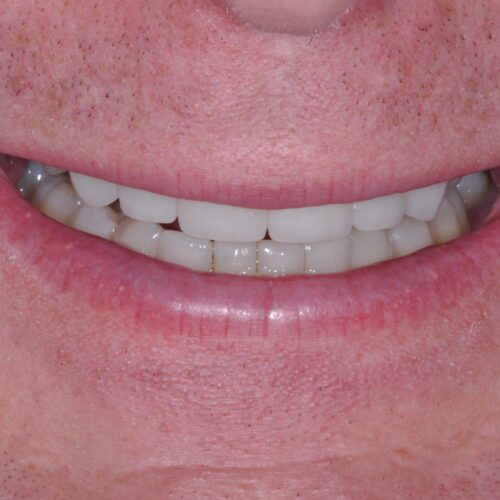 After dentistry at Beach Cities Dental Group