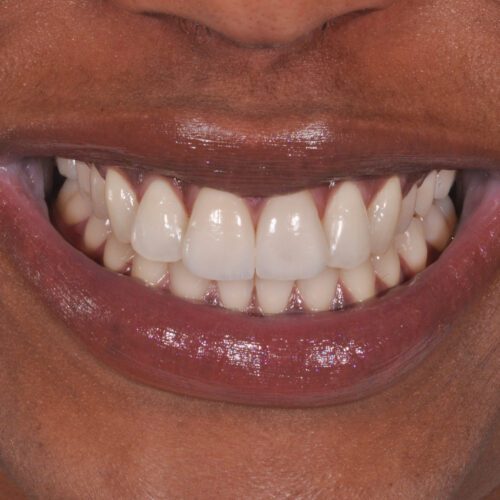 After dentistry at Beach Cities Dental Group
