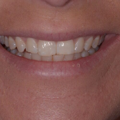 Before dentistry at Beach Cities Dental Group