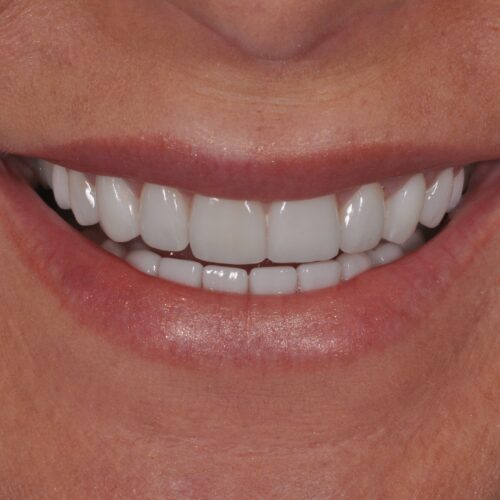 After dentistry at Beach Cities Dental Group