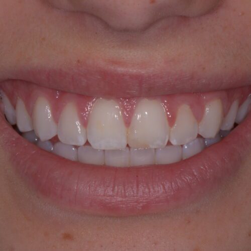 Before dentistry at Beach Cities Dental Group