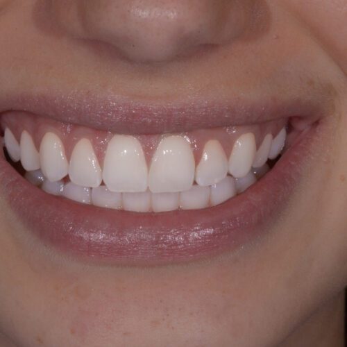 After dentistry at Beach Cities Dental Group