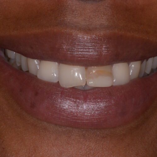 Before dentistry at Beach Cities Dental Group