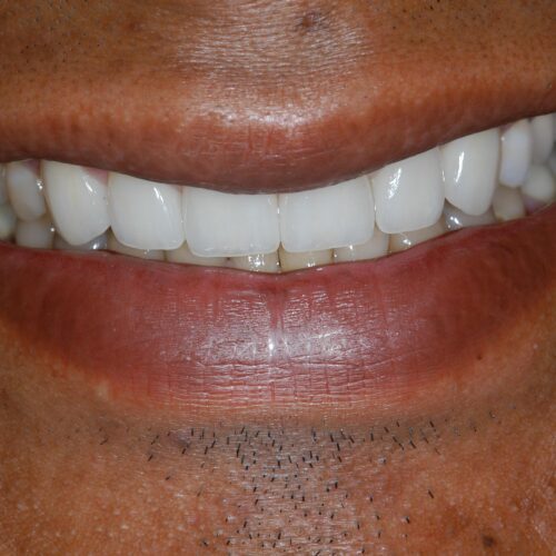 After dentistry at Beach Cities Dental Group