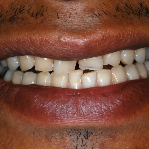 Before dentistry at Beach Cities Dental Group