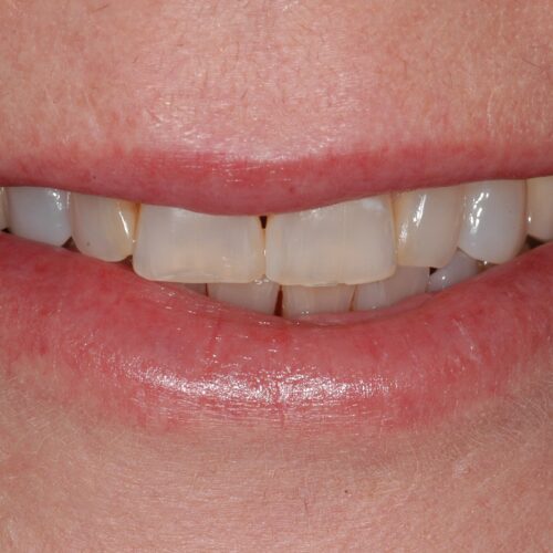 Before dentistry at Beach Cities Dental Group