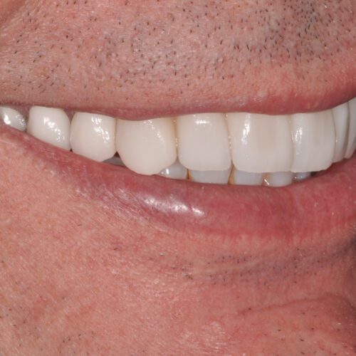After dentistry at Beach Cities Dental Group