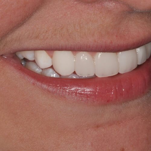After dentistry at Beach Cities Dental Group