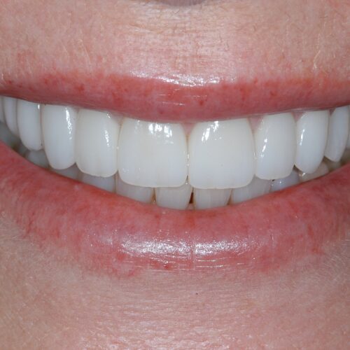 After dentistry at Beach Cities Dental Group